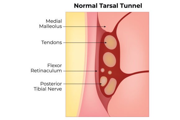 Download Normal Tarsal Tunnel Science Design - Tunnel Collection